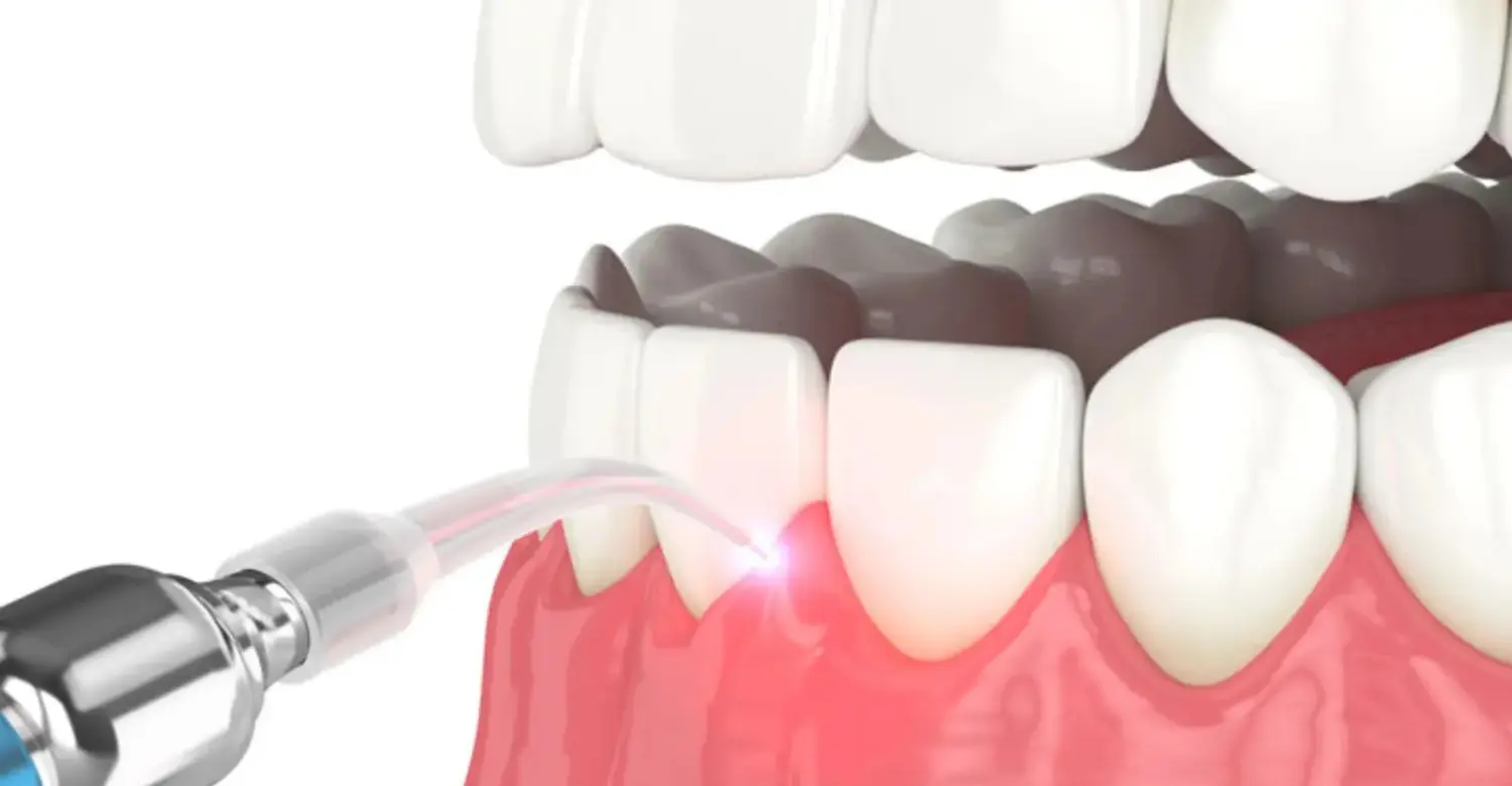 How Long Does Laser Gum Reshaping Take to Heal 2
